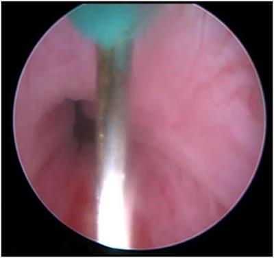 The Long-term Effect of Superficial Bladder Neck Incision on Ejaculation and Incontinence in Boys with Primary and Secondary Bladder Neck Obstruction